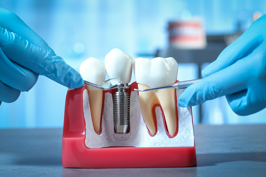 what is a dental implant?