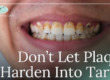 teeth with tartar